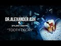 Dr Alexander Ash, DDS | Tooth Decay