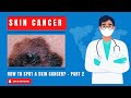 DOCTOR TALKS ABOUT HOW TO SPOT A SKIN CANCER - PART 2