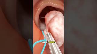 Colon Polypectomy Procedure (3D Animation) #colonpolyp #colonpolypectomy #polypectomy #colonoscopy