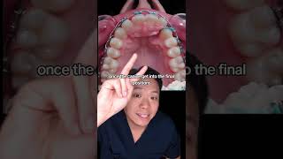 How to Fix Impacted Canines - Dentist Explains! #canines #orthodontics #braces