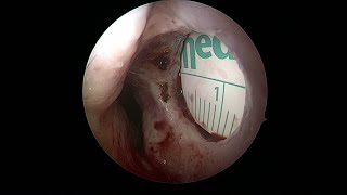 endoscopic septal perforation repair