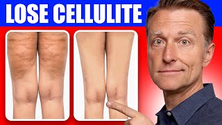 A BETTER Way to Lose Flabby Cellulite on Your Hips, Thighs and Buttocks - Dr. Berg