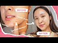 3 TIPS that CLEARED My ACNE!