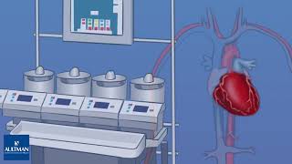 On Pump Coronary Artery Bypass Graft (CABG)