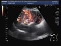 Ultrasound Video showing a hepatic mass.