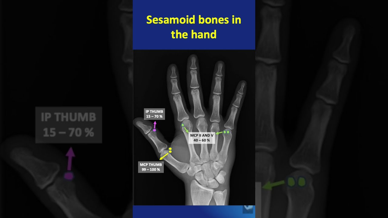 Digital Paleopathology: How We Diagnose Diseases in a 66-Million-Year-Old Patient
