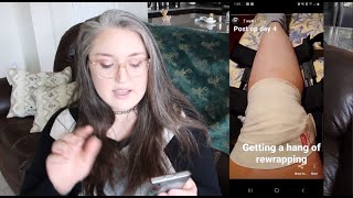 MPFL 6 Months Update | MPFL Reconstruction, Knee surgery
