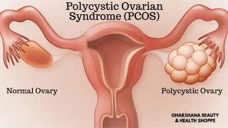 What is PCOS |Polycystic Ovarian Syndrome | Symptoms, Causes, Risk & Treatment