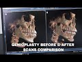 Jaw Surgery Transformation: A Before and After Scans Comparison