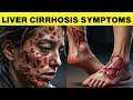 Early  LIVER CIRRHOSIS SYMPTOMS You Shouldn't Ignore (WARNING !!)