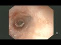 Esophageal Stricture in immunocompromised patient