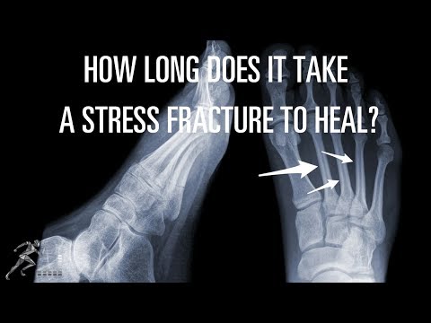 How long does it take a stress fracture to heal? How long does it take a stress fracture to heal?