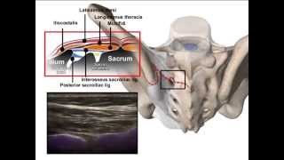 ULTRASOUND SACROILIAC JOINT INFILTRATION