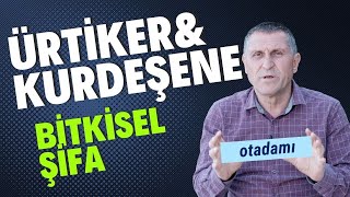 ÜRTİKER KURDEŞEN NEDİR KURDEŞENE ÜRTİKERE İYİ GELEN BİTKİLER NASIL GEÇER BİTKİSEL TEDAVİ İYİ GELİR