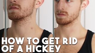HOW TO: Get Rid of a Hickey in Two Minutes
