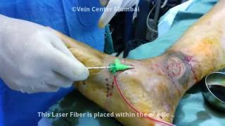 Laser Treatment of Varicose Veins