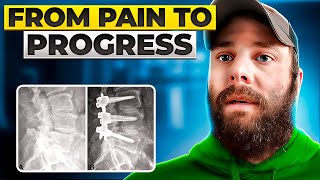 Spinal Fusion: From Pain to Progress in 2 Months - My Story