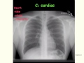 How to read a chest xray, the basics