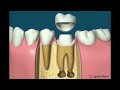 Root Canal Treatment RCT (Step by Step Animation)