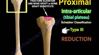Tibial Plateau Fracture Fixation, Proximal Tibia - Everything You Need To Know - Dr. Nabil Ebraheim