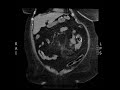 Subcapsular Hematoma, CT Coronal. JETem 2018