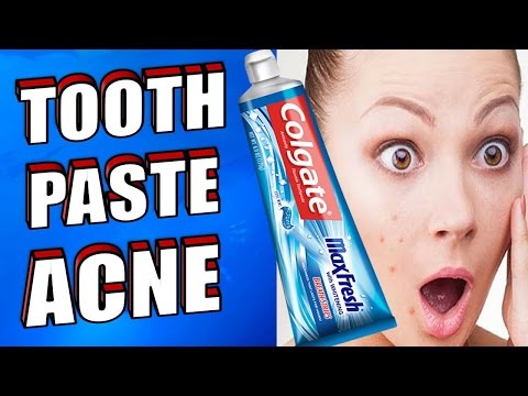 How To Apply Toothpaste on Pimples, Acne, Spots & Zits How To Apply Toothpaste on Pimples, Acne, Spots & Zits