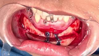 Jaw surgery with plates and screws - Maxillofacial And Orthognathic procedure