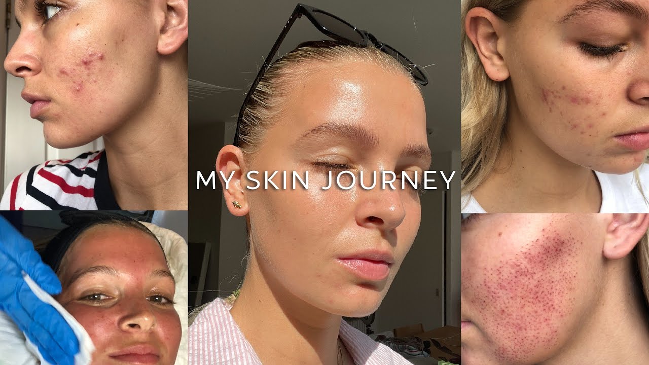 My Skin Journey / Morpheus 8 Treatment / Adult Acne / Acne Scarring ...