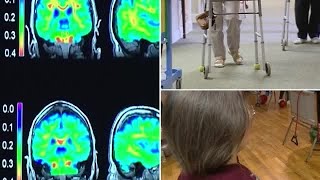 Alzheimer's Breakthrough Gives Patients Hopes