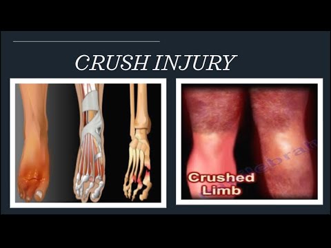 Crush Injury| Crush Syndrome Causes And Treatment - YouTube