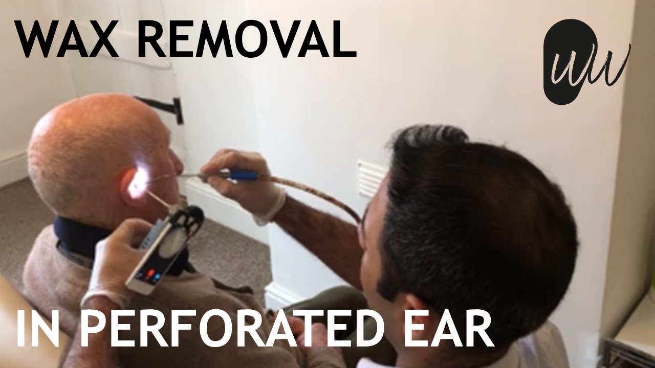 Ear Wax Removal In Ear With Perforated Eardrum - #388 - YouTube