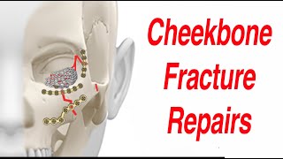 Tripod & Other Cheekbone Facial Fractures
