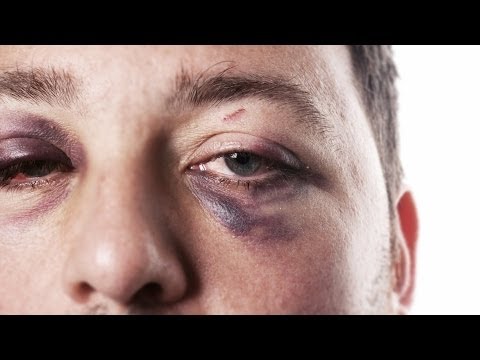 How to Treat a Black Eye | First Aid Training How to Treat a Black Eye | First Aid Training