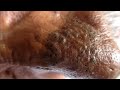 HUGE NOSE BLACKHEADS REMOVAL AND ACNE TREATMENT | WHITEHEADS REMOVAL