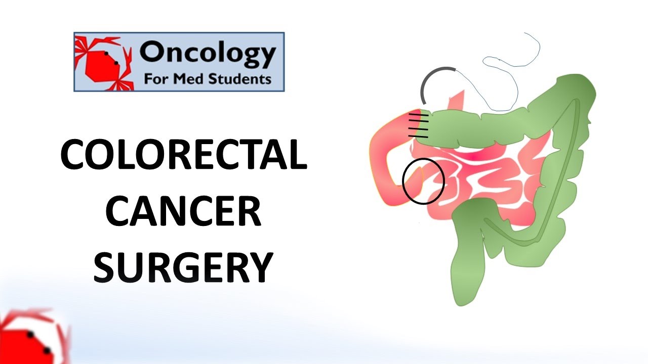 Colorectal Cancer Surgery: Principles And Types - YouTube