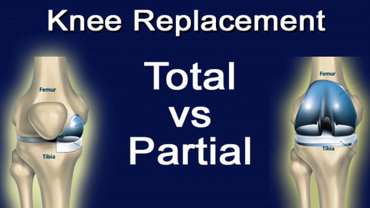 The Difference Between Total Knee Replacement And Partial Knee ...