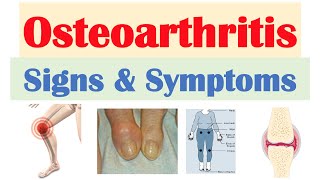 Osteoarthritis Signs & Symptoms (& Why They Occur)