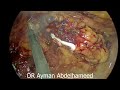 laparoscopic abdominoperineal resection apr for low rectal cancer