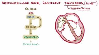 Atrioventricular reentrant tachycardia AVRT \u0026 nodal reentrant tachycardia AVNRT