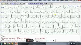 ASHRY GROUP Holter ECG 48 Hours Recorder and Analysis