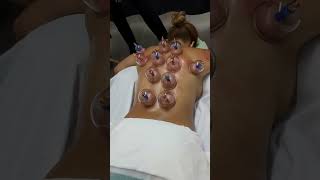Unleash the healing powers of cupping therapy
