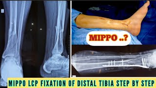 MIPPO LCP FIXATION DISTAL TIBIA STEP BY STEP |Comminuted # Distal Tibia Minimal invasive fixation 🔥