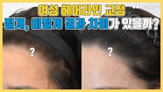 여성헤어라인교정 절개 비절개 결과 차이가 있다!?🧐｜전지훈 원장｜모엠의원(MOEM)