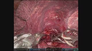 Robotic Right Lower Lobe Superior Segmentectomy