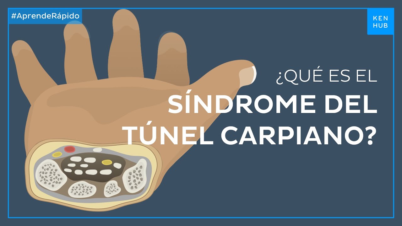 Síndrome Del Túnel Carpiano: Síntomas, Causas, Tratamiento - Anatomía ...