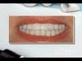 Esthetic Dentistry All Porcelain Crowns