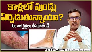 కాళ్లలో పుండ్లు ఏర్పడుతున్నాయా? | How to Deal with Leg Ulcers? | Diabetic Foot | Wound Care Hospital