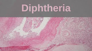 Diphtheria - Pathology mini tutorial
