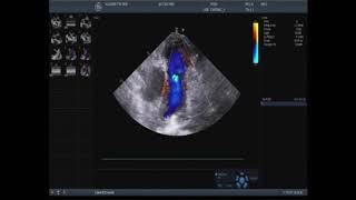 Asvide: The opening of left coronary artery fistula to pulmonary artery with the jet