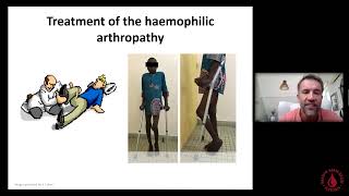 Sébastien Lobet - Orthopedic problems in patients with hemophilia